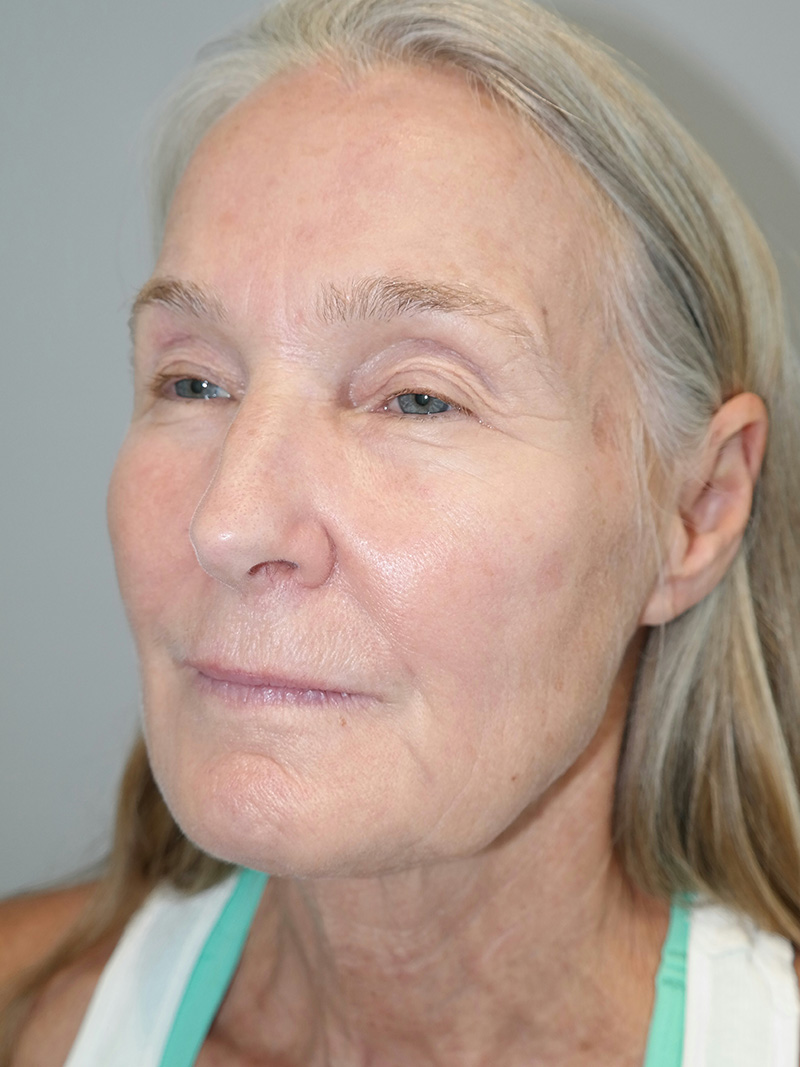 Facelift Before and After 03 | Sanjay Grover MD FACS