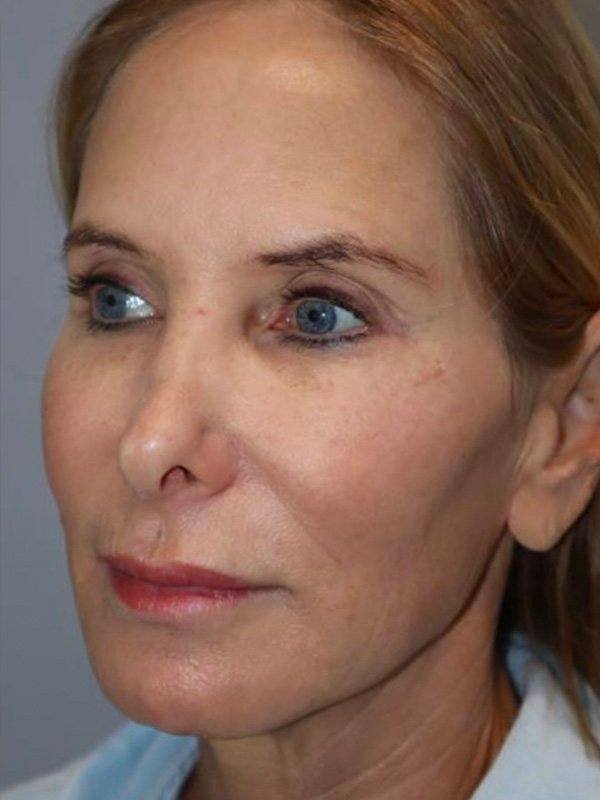 Facelift Before and After 03 | Sanjay Grover MD FACS