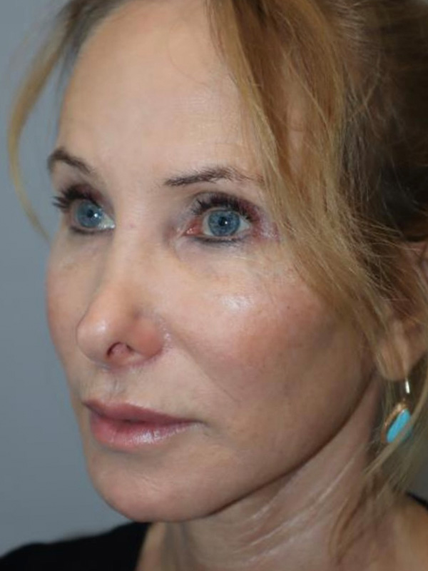 Facelift Before and After 03 | Sanjay Grover MD FACS