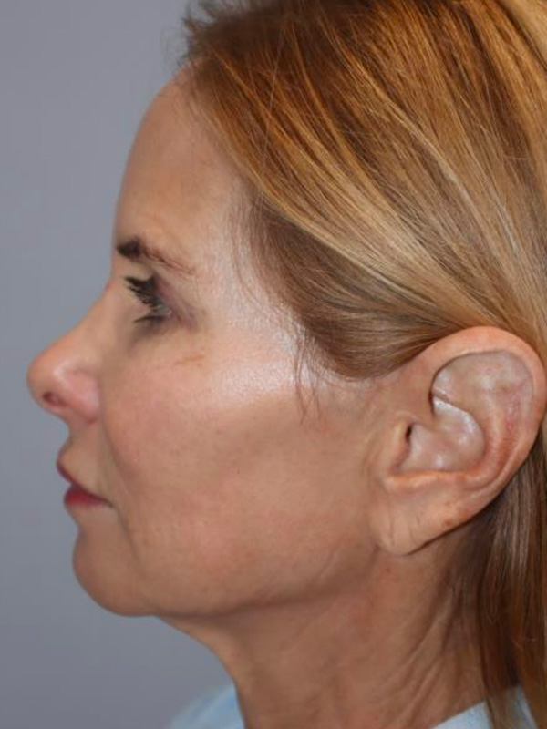 Facelift Before and After 03 | Sanjay Grover MD FACS