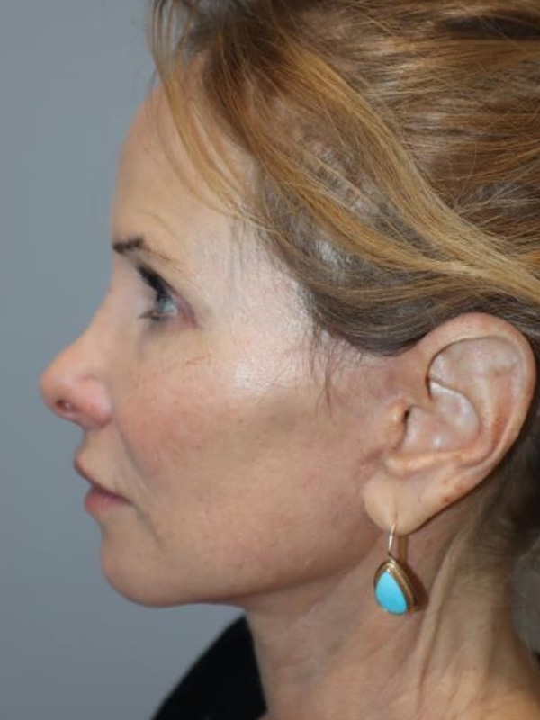 Facelift Before and After 03 | Sanjay Grover MD FACS