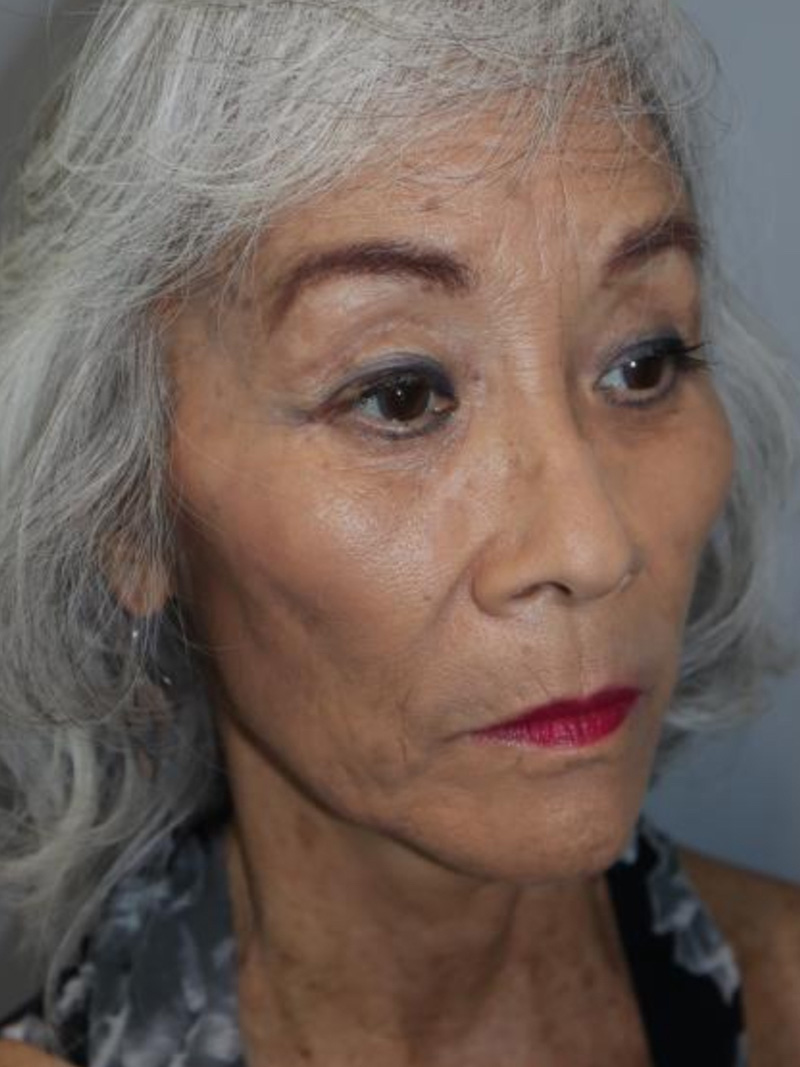Facelift Before and After | Grover Aesthetics