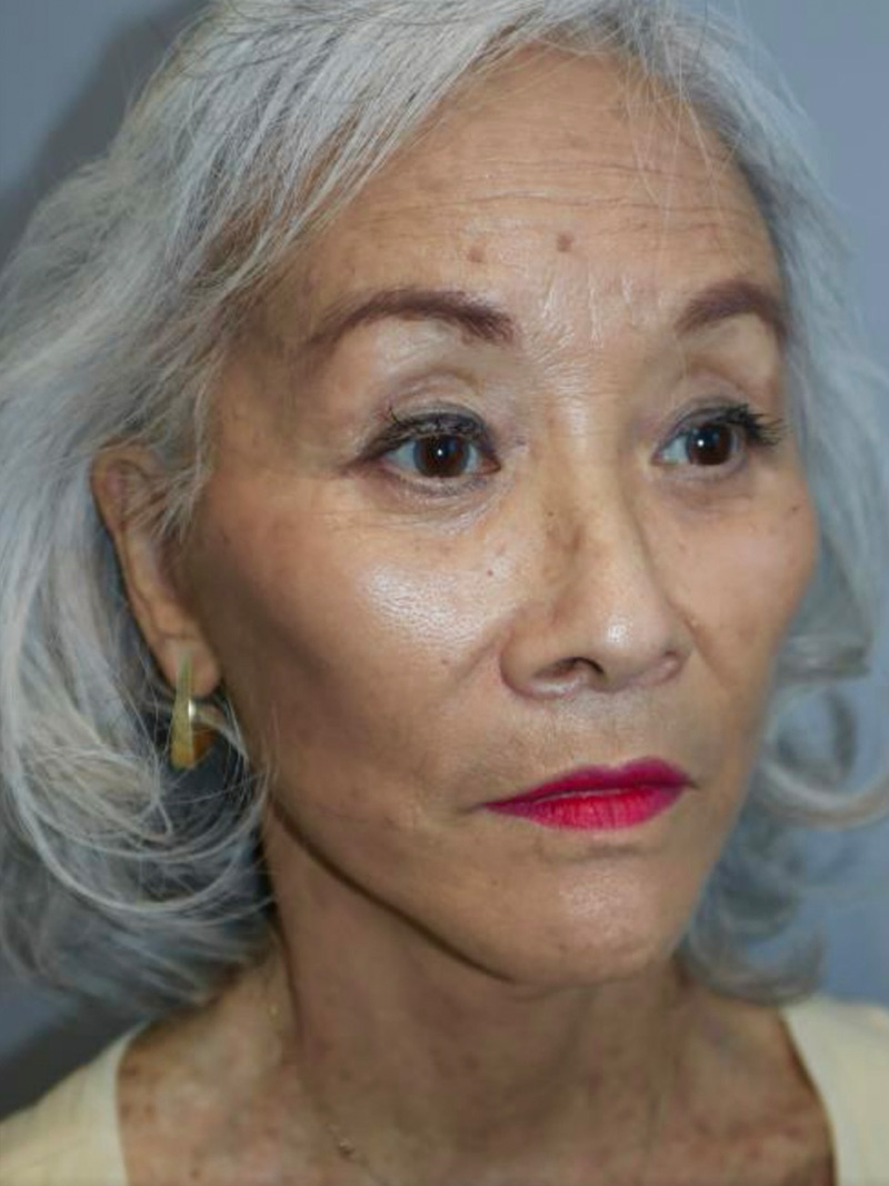 Facelift Before and After | Grover Aesthetics