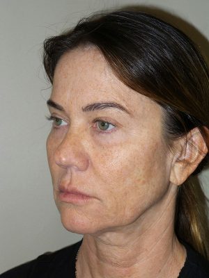 Facelift Before and After 04 | Sanjay Grover MD FACS