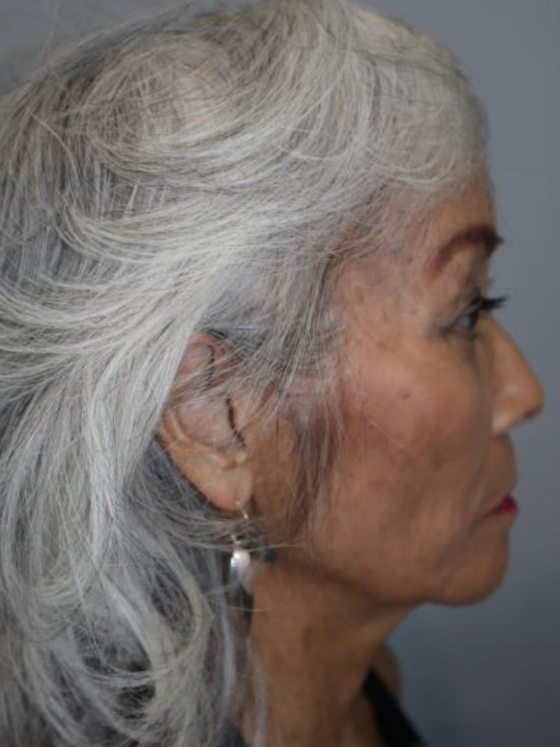 Facelift Before and After 04 | Sanjay Grover MD FACS