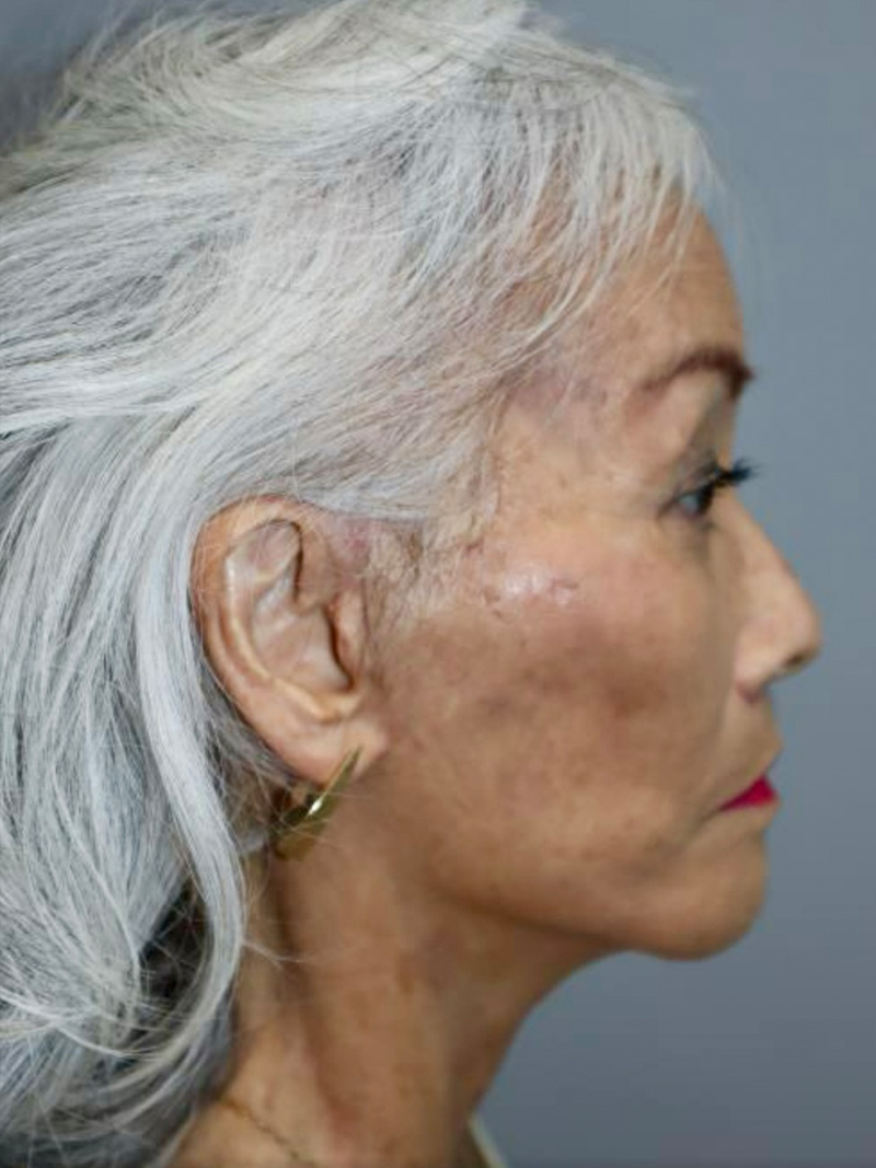 Facelift Before and After 04 | Sanjay Grover MD FACS