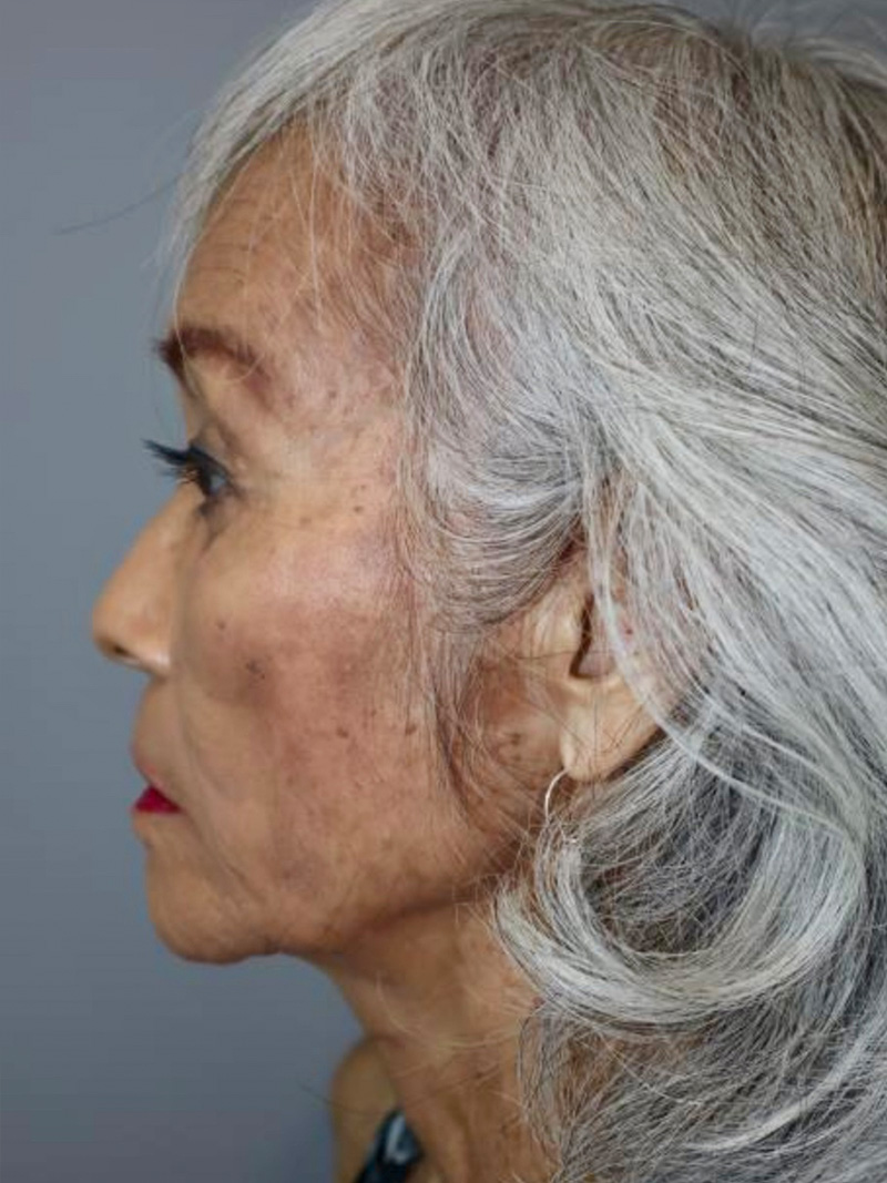 Facelift Before and After 04 | Sanjay Grover MD FACS