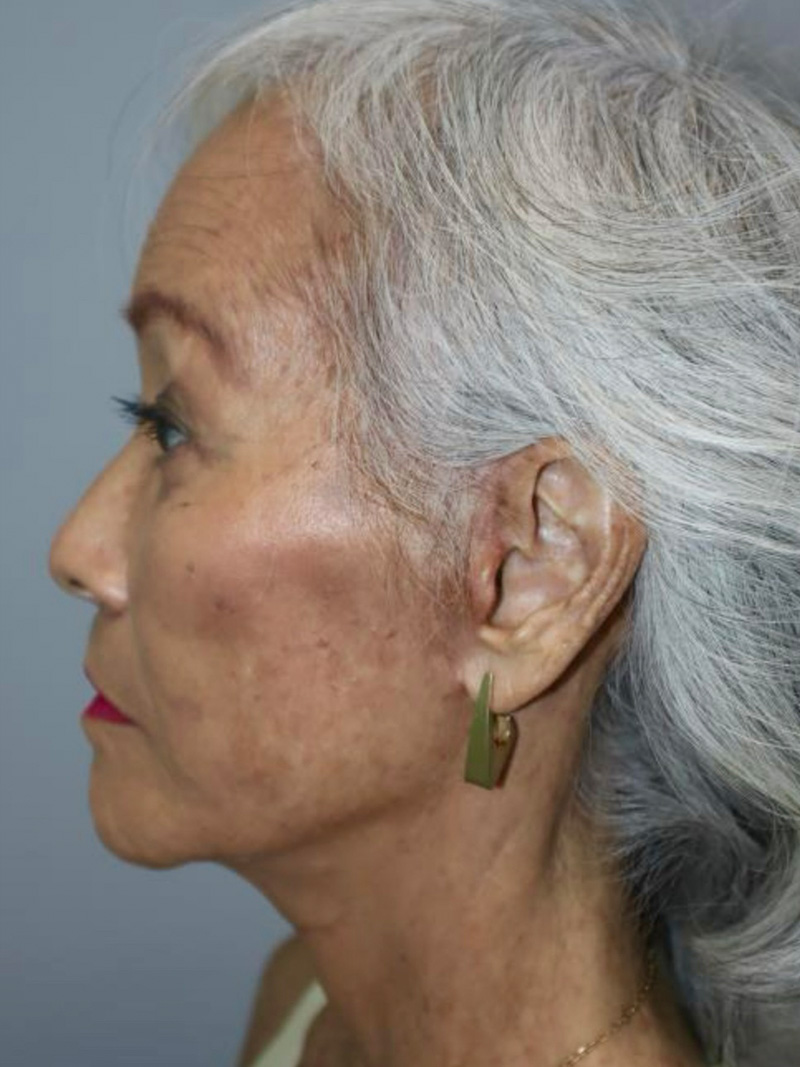 Facelift Before and After 04 | Sanjay Grover MD FACS