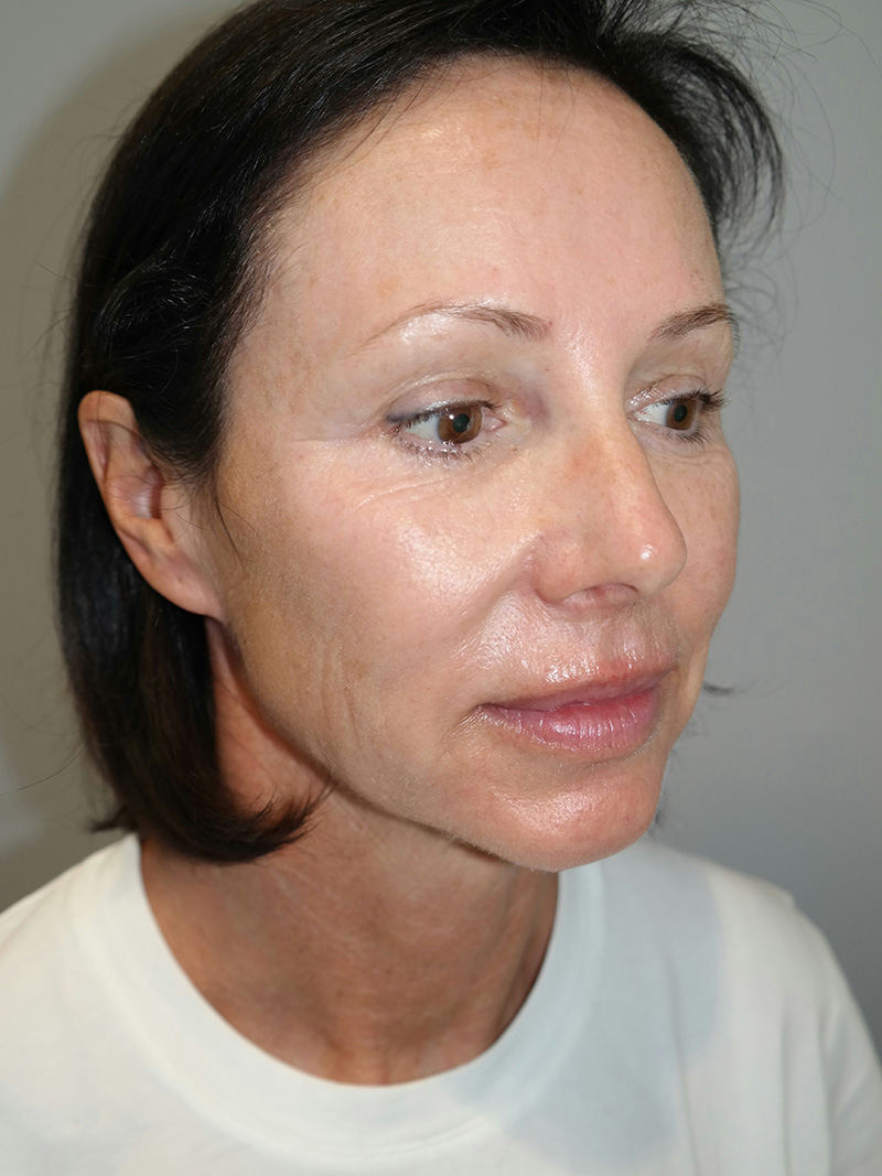 Facelift Before and After | Sanjay Grover MD FACS