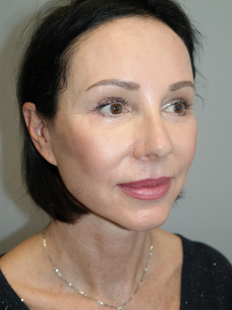 Facelift Before and After 05 | Sanjay Grover MD FACS