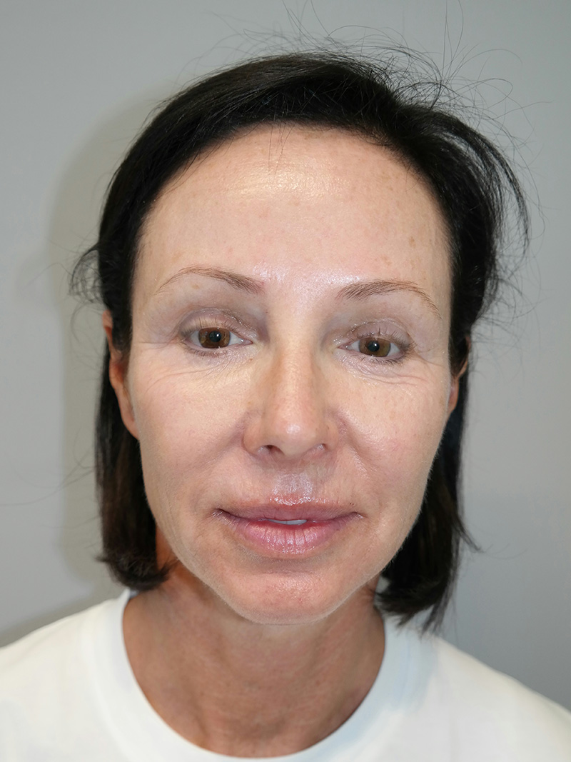 Facelift Before and After 05 | Sanjay Grover MD FACS