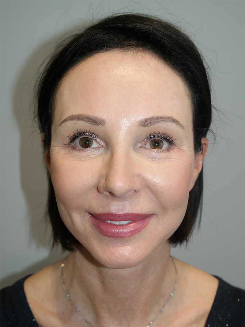 Facelift Before and After 05 | Sanjay Grover MD FACS