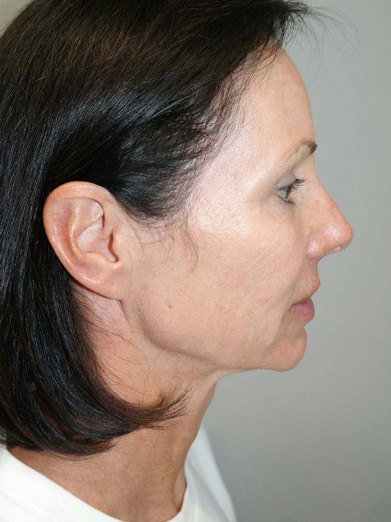 Facelift Before and After 05 | Sanjay Grover MD FACS