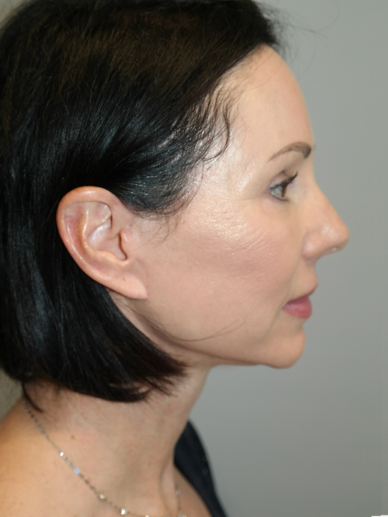 Facelift Before and After 05 | Sanjay Grover MD FACS