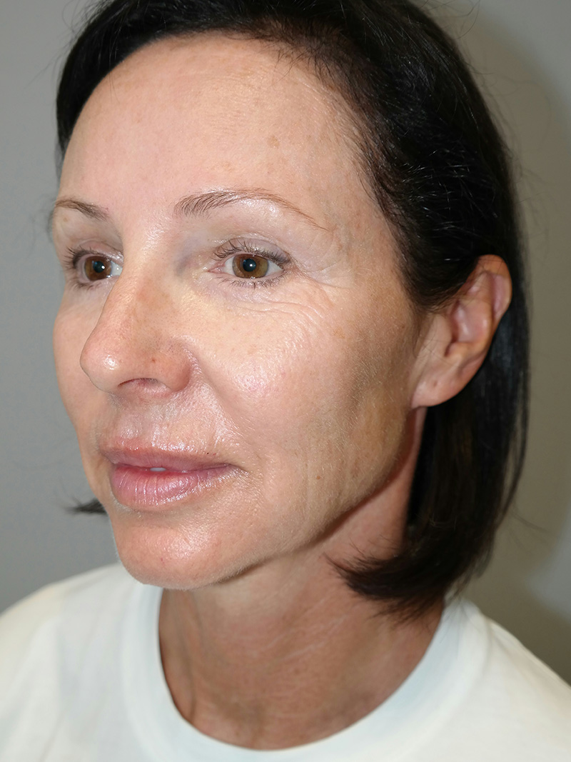 Facelift Before and After 05 | Sanjay Grover MD FACS