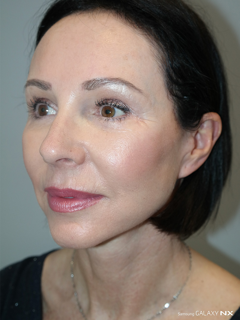 Facelift Before and After 05 | Sanjay Grover MD FACS