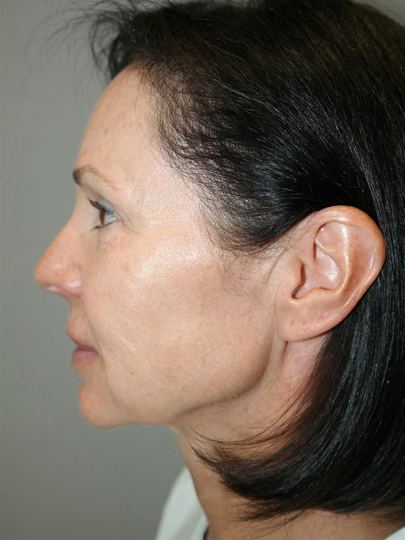 Facelift Before and After 05 | Sanjay Grover MD FACS