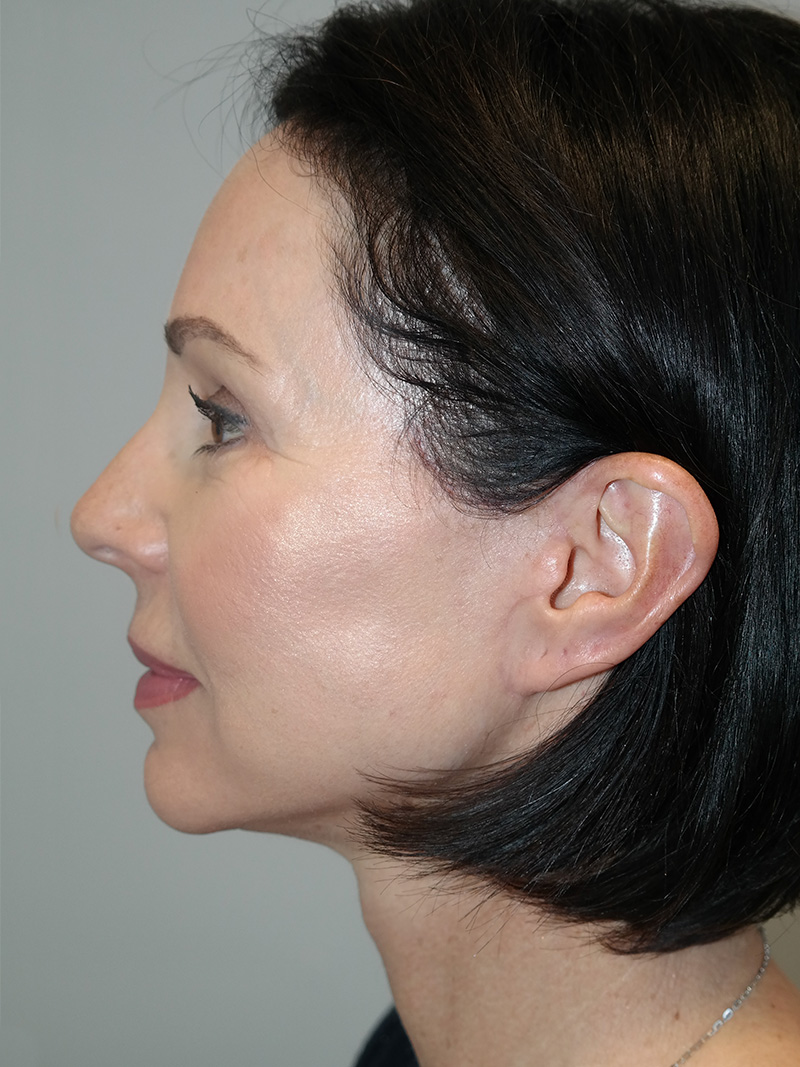 Facelift Before and After 05 | Sanjay Grover MD FACS