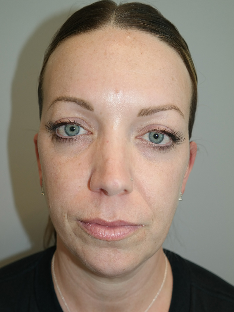 Facelift Before and After 06 | Sanjay Grover MD FACS