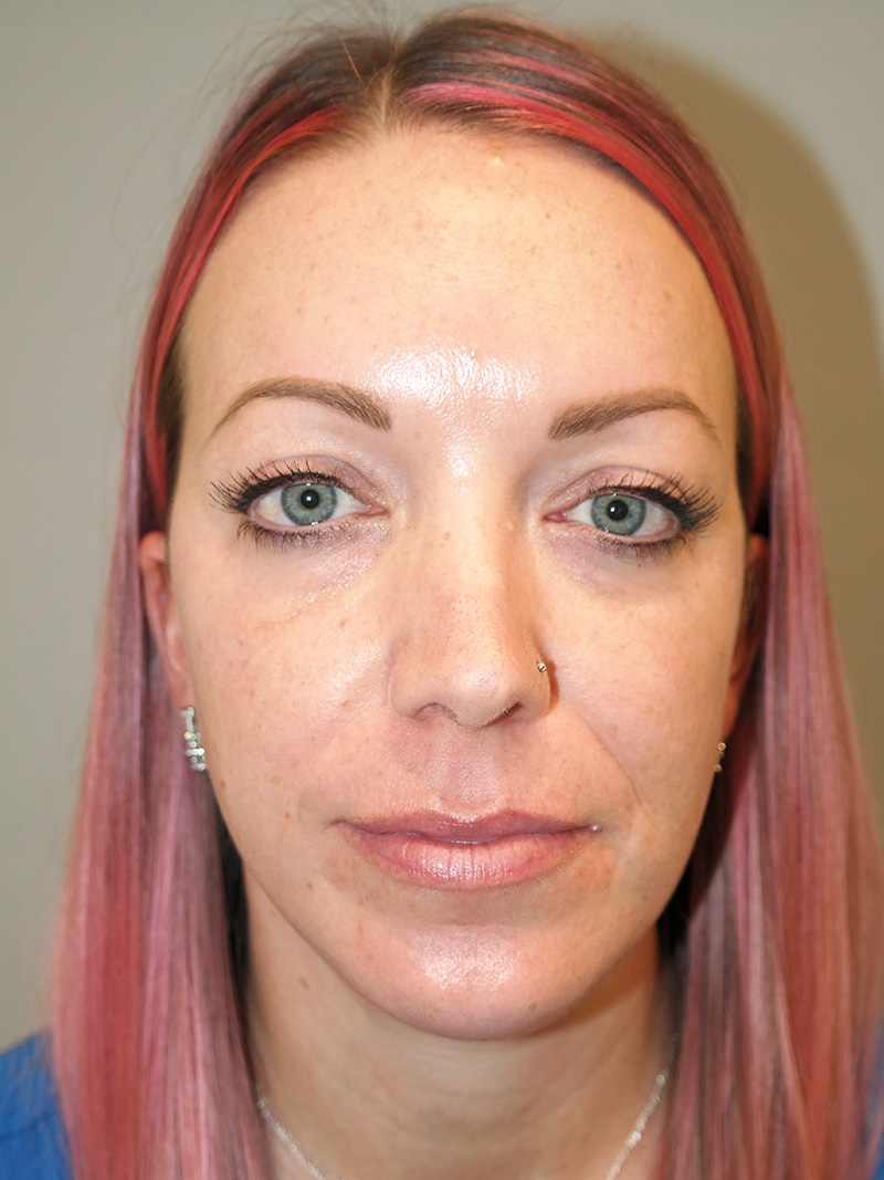 Facelift Before and After 06 | Grover Aesthetics