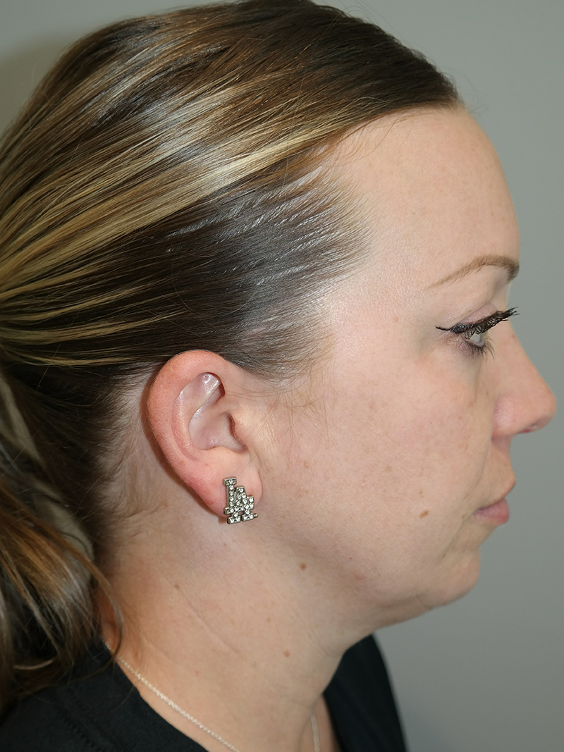 Facelift Before and After 06 | Grover Aesthetics