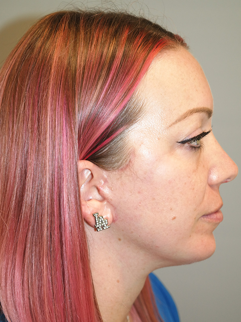 Facelift Before and After 06 | Grover Aesthetics