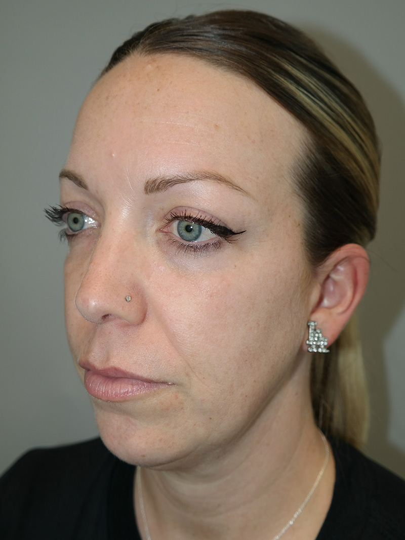 Facelift Before and After 06 | Grover Aesthetics