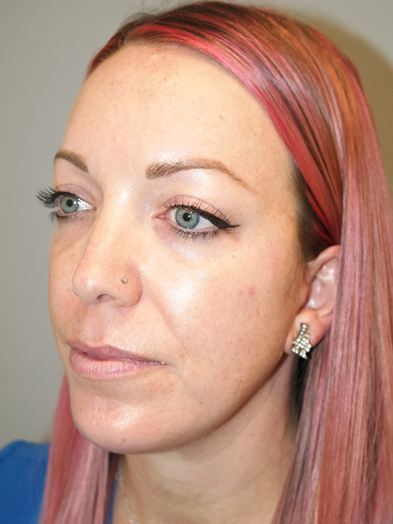 Facelift Before and After 06 | Grover Aesthetics