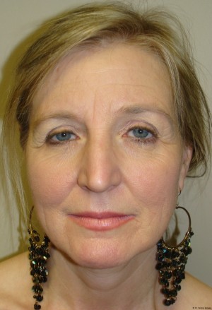 Facelift Before and After 06 | Sanjay Grover MD FACS