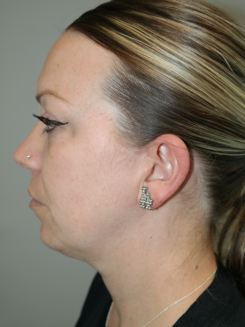 Facelift Before and After 06 | Grover Aesthetics