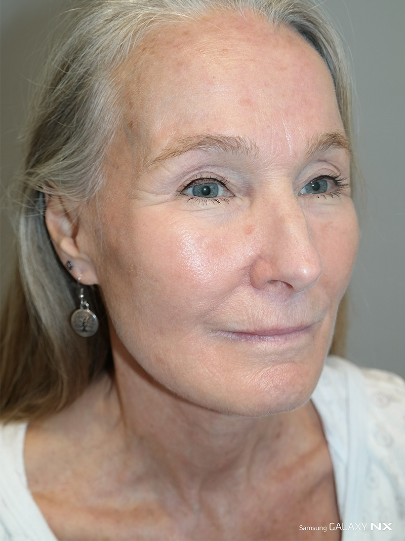 Facelift Before and After 07 | Sanjay Grover MD FACS