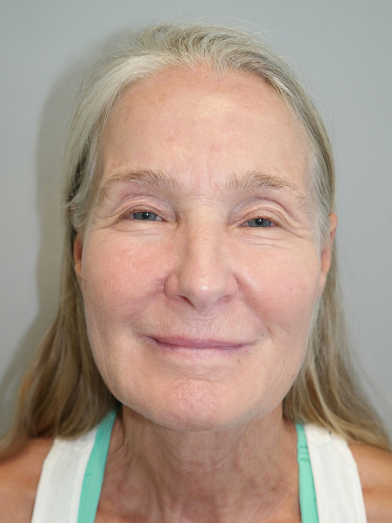 Facelift Before and After 07 | Sanjay Grover MD FACS