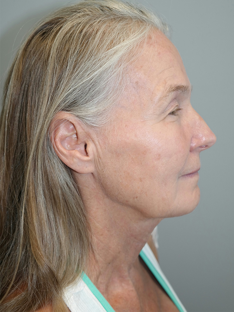 Facelift Before and After 07 | Sanjay Grover MD FACS