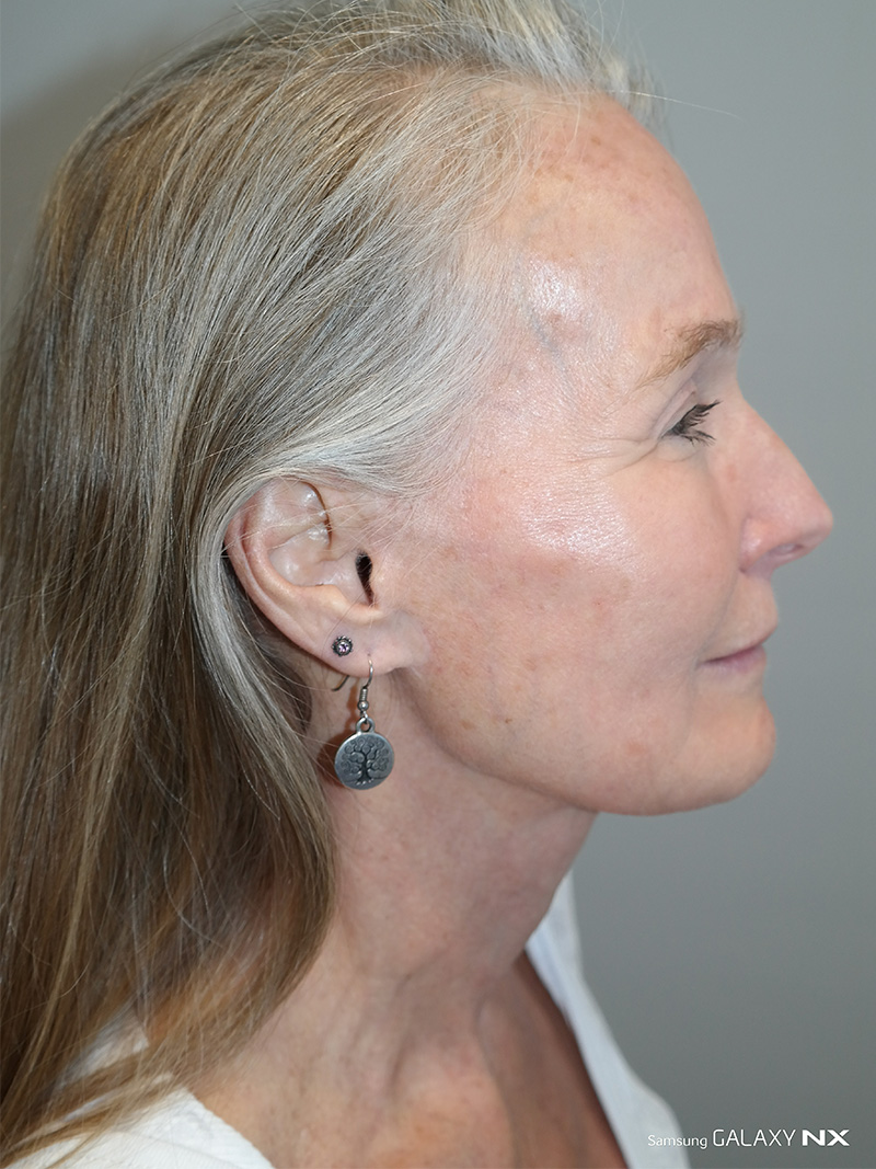 Facelift Before and After 07 | Sanjay Grover MD FACS