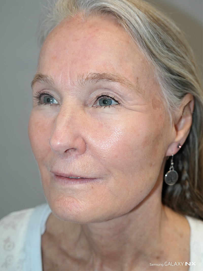 Facelift Before and After 07 | Sanjay Grover MD FACS