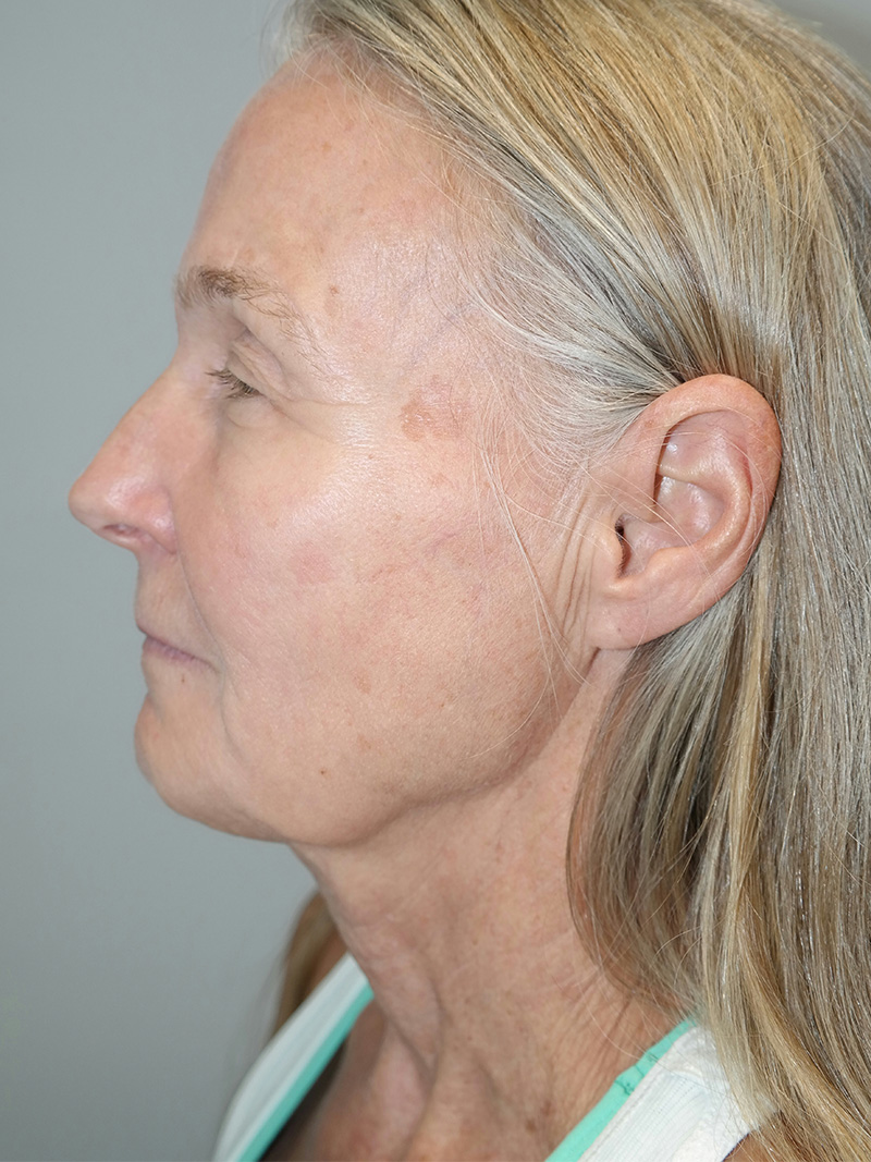 Facelift Before and After 07 | Sanjay Grover MD FACS