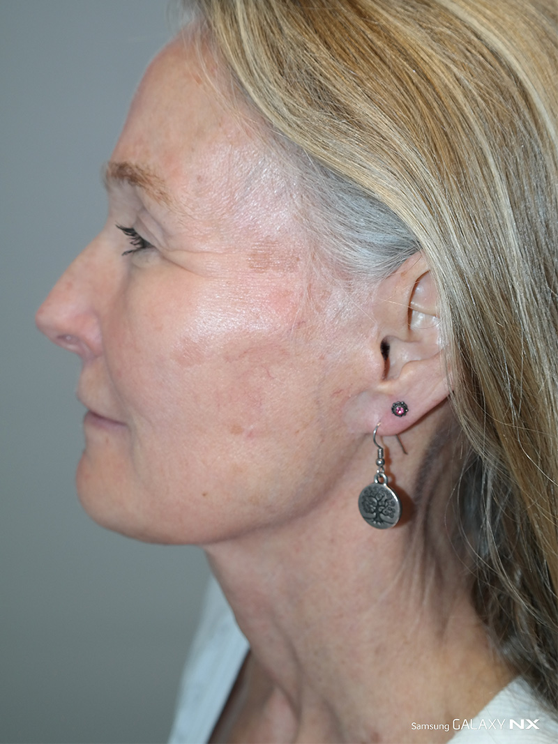 Facelift Before and After 07 | Sanjay Grover MD FACS