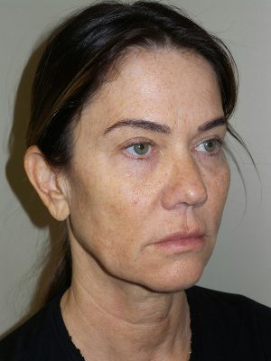 Facelift Before and After | Grover Aesthetics