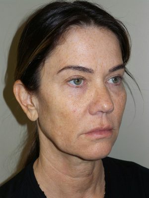 Facelift Before and After 27 | Sanjay Grover MD FACS