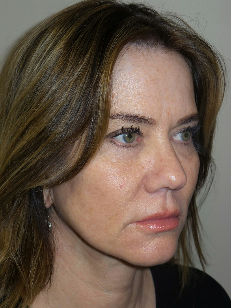 Facelift Before and After 08 | Sanjay Grover MD FACS