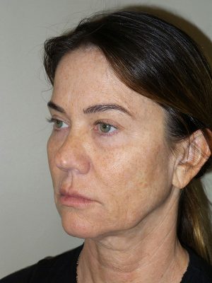 Facelift Before and After 08 | Sanjay Grover MD FACS