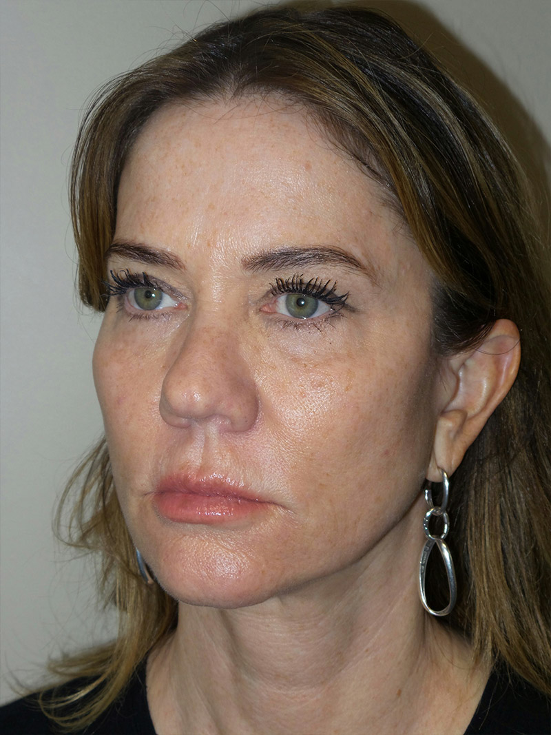 Facelift Before and After 08 | Sanjay Grover MD FACS