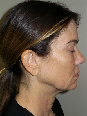 Facelift Before and After 08 | Sanjay Grover MD FACS