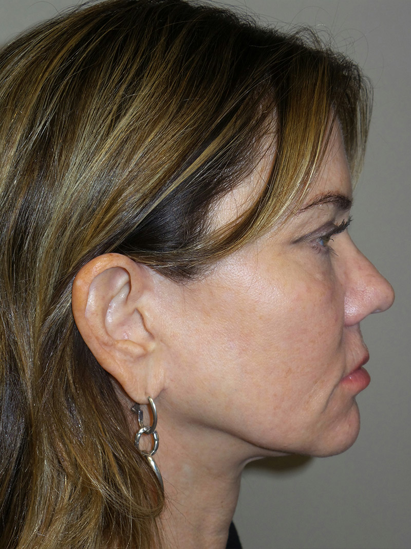 Facelift Before and After 08 | Sanjay Grover MD FACS