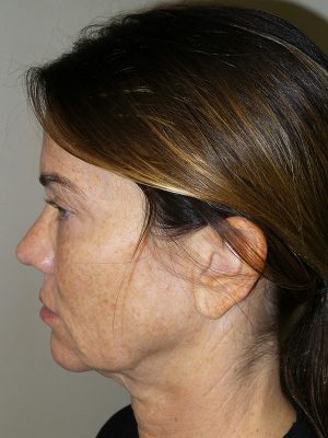 Facelift Before and After 08 | Sanjay Grover MD FACS