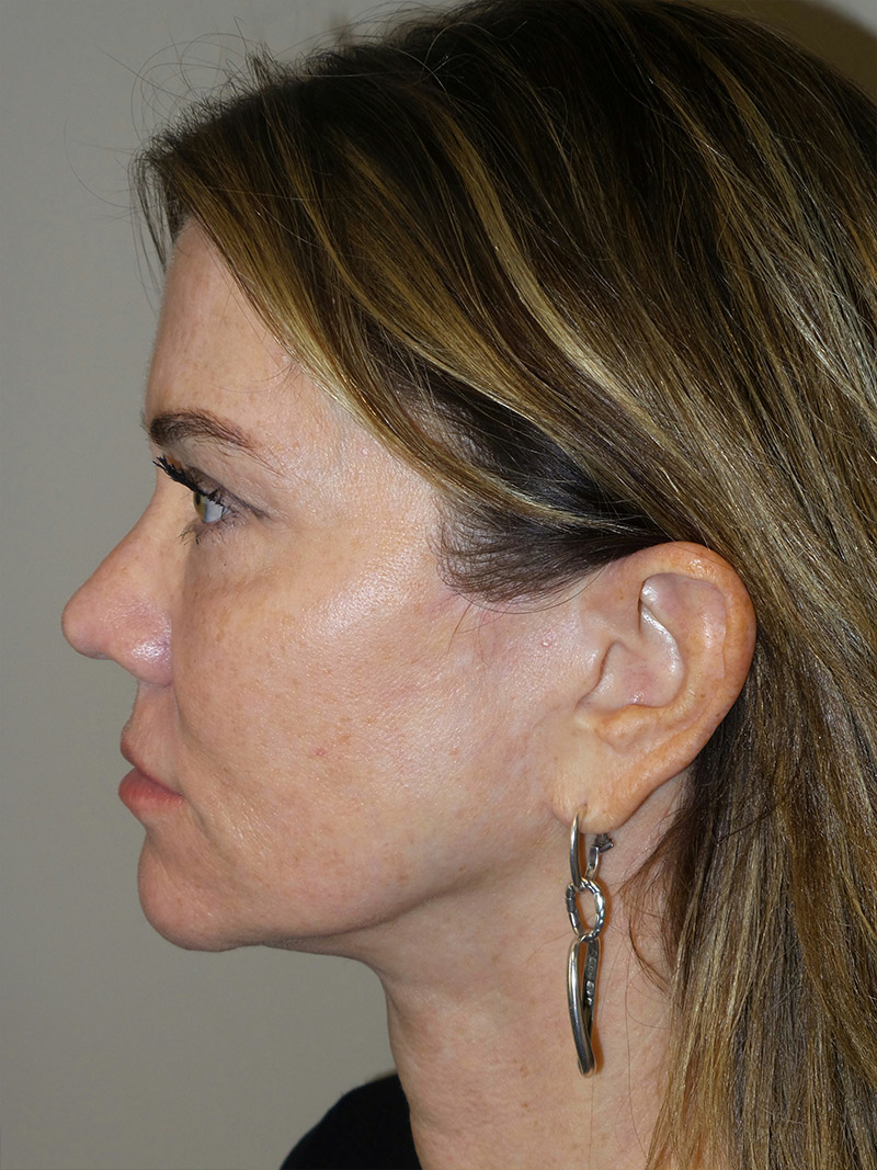 Facelift Before and After 08 | Sanjay Grover MD FACS