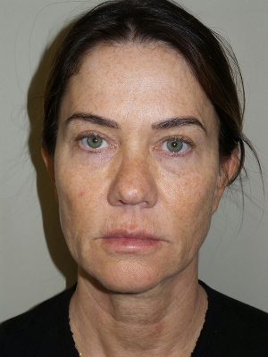 Facelift Before and After 08 | Sanjay Grover MD FACS