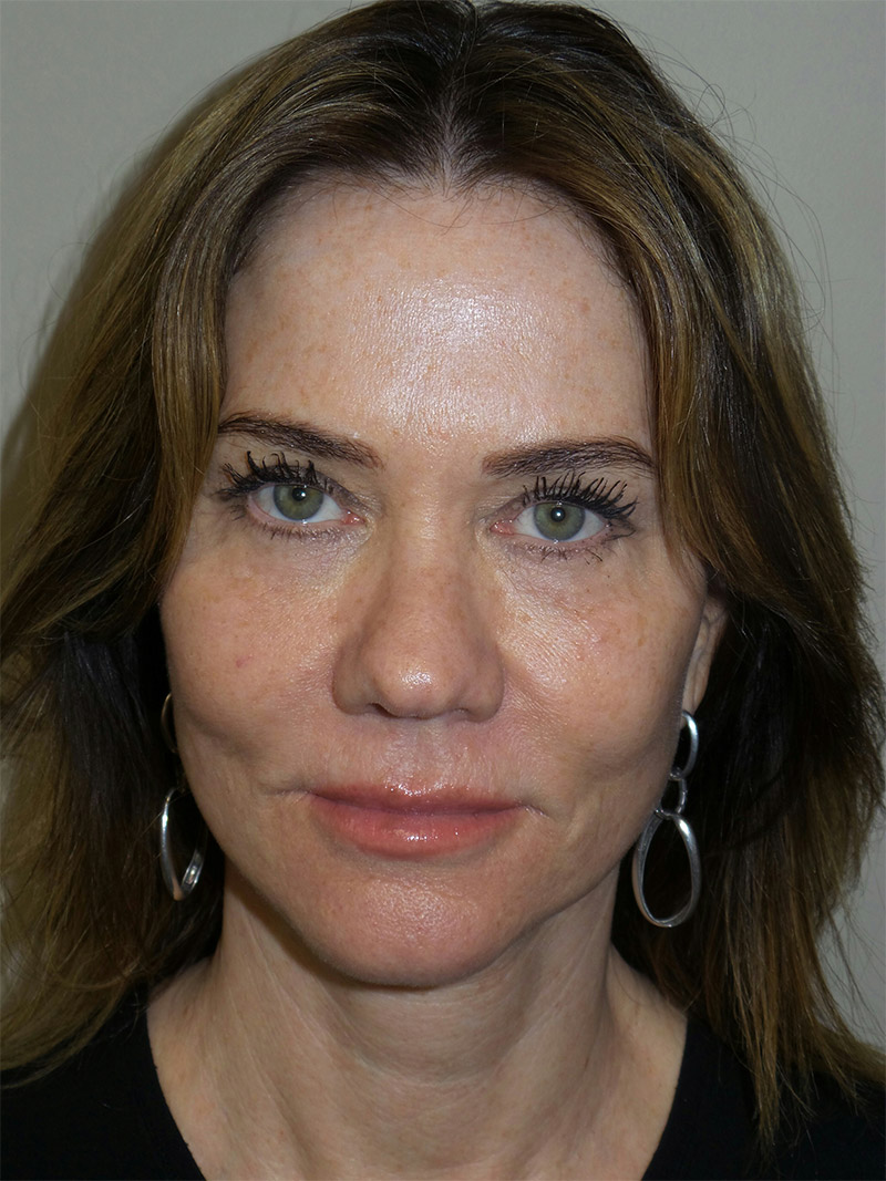 Facelift Before and After 08 | Sanjay Grover MD FACS