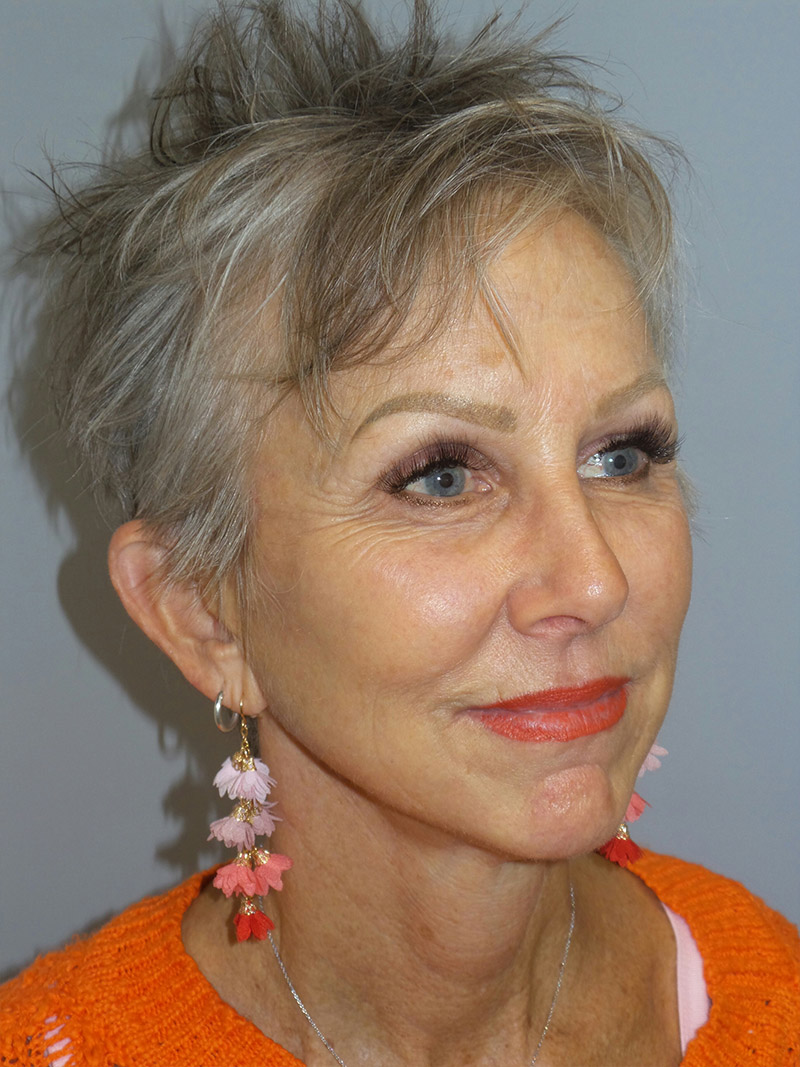 Facelift Before and After | Grover Aesthetics