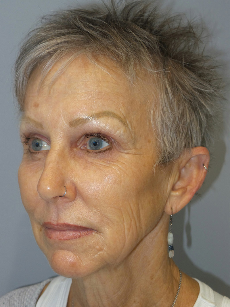 Facelift Before and After 09 | Sanjay Grover MD FACS